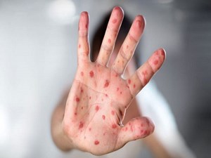 آغاز واکسیناسیون تکمیلی سرخک و سرخجه برای کودکان خوزستانی