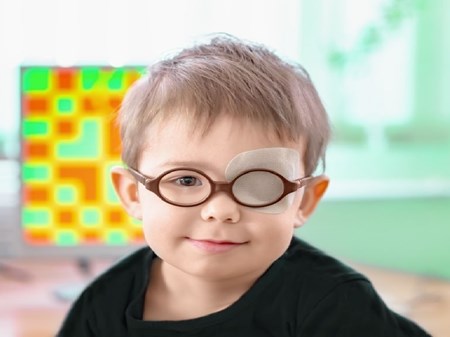 درمان بیش از ۱۳ هزار مورد تنبلی چشم در کودکان