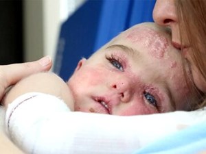 شناسایی بیش از ۴۰ بیمار «پروانه‌ای» در خوزستان/ چالش دسترسی به داروهای حیاتی