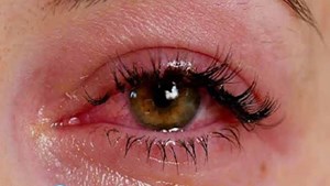 خطرات پنهان اکستنشن مژه برای سلامت چشم