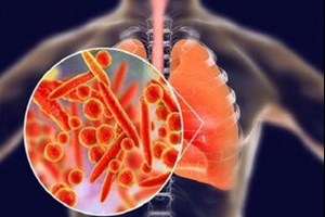 یک متخصص بیماری‌های عفونی تشریح کرد: پنومونی؛ همچنان بزرگ‌ترین قاتل عفونی جهان / ضرورت تقویت واکسیناسیون جهت مهار مرگ‌ومیر ذات‌الریه