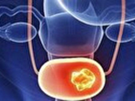 ایران در منطقه کمربند سنگ کلیه/ آلودگی هوا و استعمال دخانیات سبب بروز سرطان مثانه + فیلم