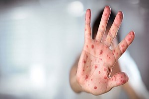 شناسایی ۶۷۴ ابتلا به سرخک در سال گذشته/ هشدار؛ تبلیغات علیه واکسیناسیون در شبکه‌های اجتماعی