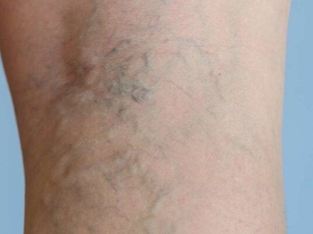با چند عادت ساده از ابتلا به واریس پیشگیری کنیم
